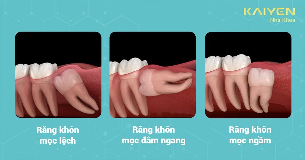 Các trường hợp răng khôn phải nhổ bỏ để không gây ảnh hưởng đến các răng kế cận