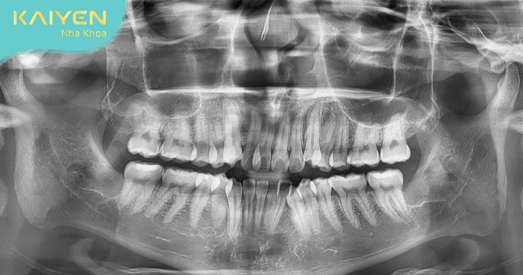 Chụp phim sau khi nhổ để xác định chính xác tình trạng răng