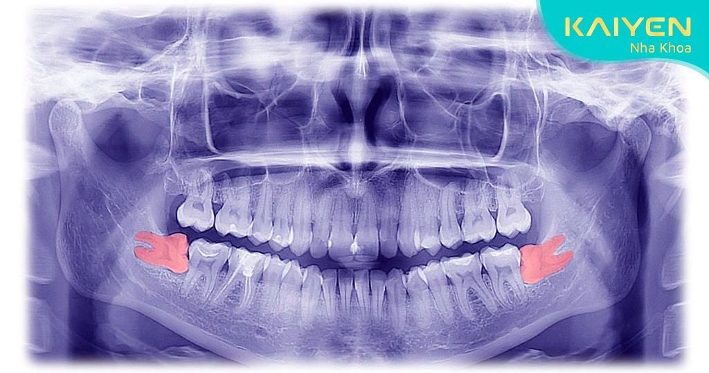 Nhổ răng khôn hàm dưới nguy hiểm hơn