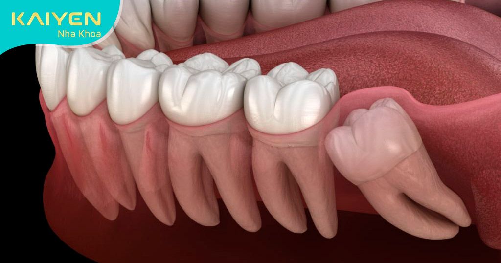 Nhổ răng khôn mọc lệch 45 độ có nguy hiểm không? Phương pháp nào tốt?