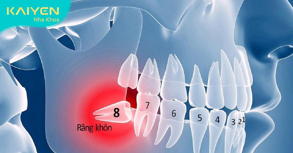 Răng khôn mọc ngang ảnh hưởng đến răng số 7 bên cạnh