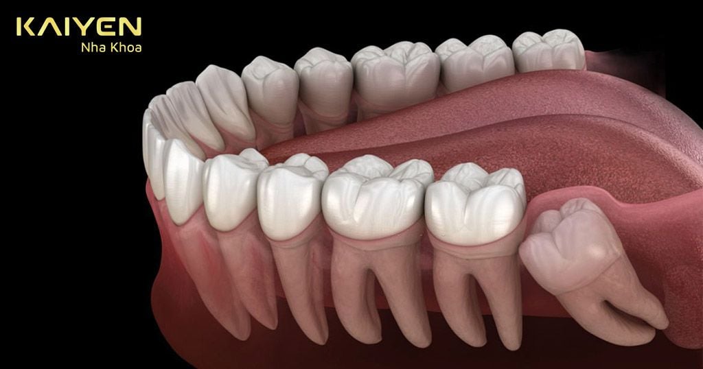 Nhổ răng khôn mọc ngầm có đau không? Giá bao nhiêu?