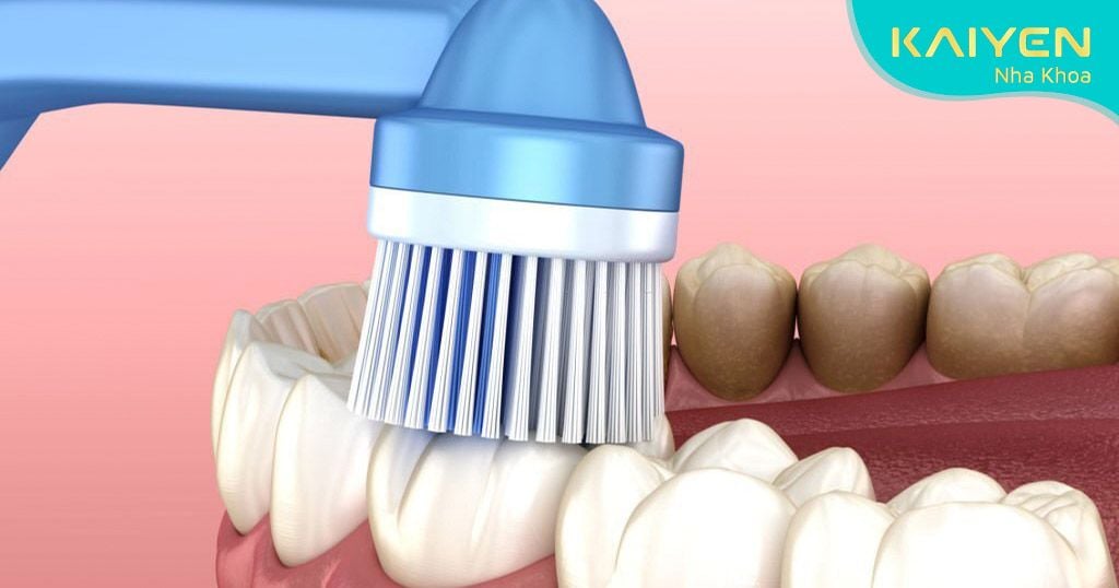 Vệ sinh răng miệng thường xuyên và đúng cách
