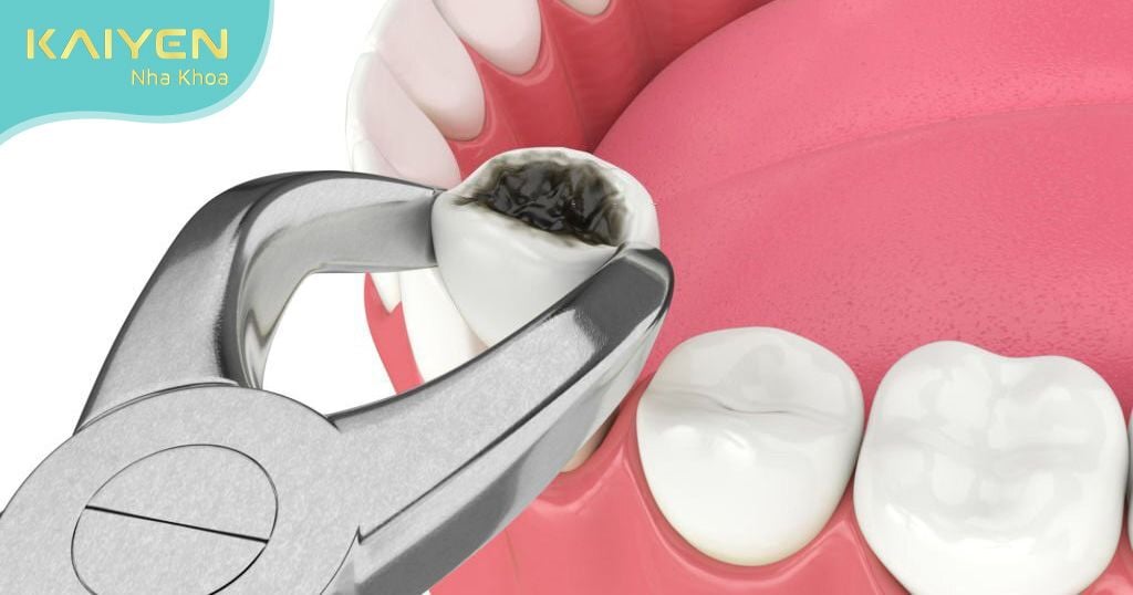 Thời gian nhổ răng phụ thuộc vào tình trạng răng và sức khỏe mỗi người