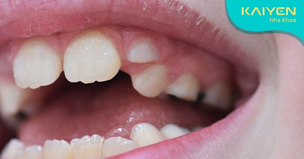 Răng dư là gì? Nhổ răng dư hàm trên có nguy hiểm không?