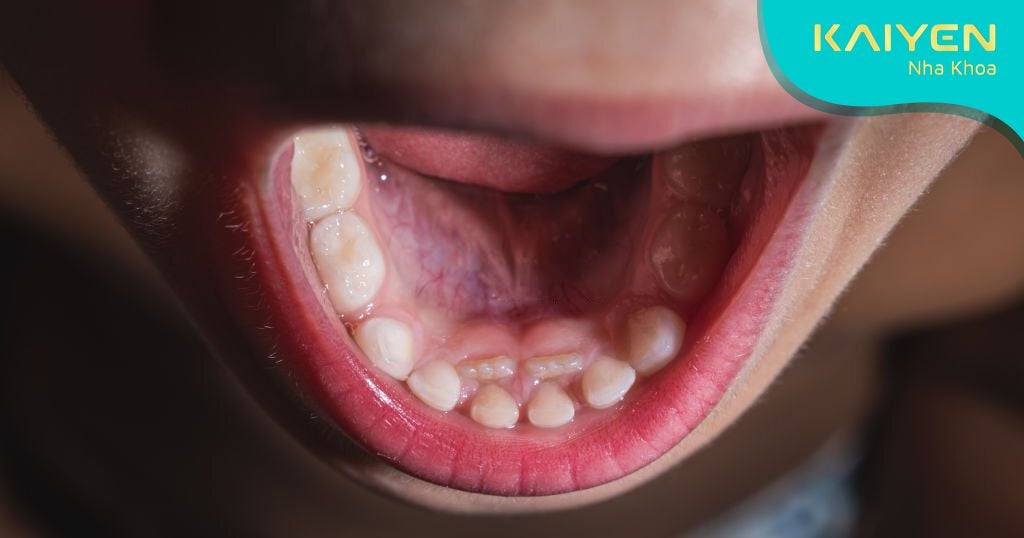 Tìm hiểu răng mọc dư là gì giúp người bệnh tìm phương án khắc phục
