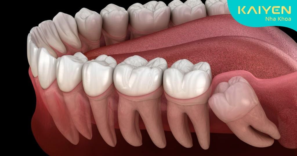 Nên nhổ răng khôn mọc ngầm, mọc lệch