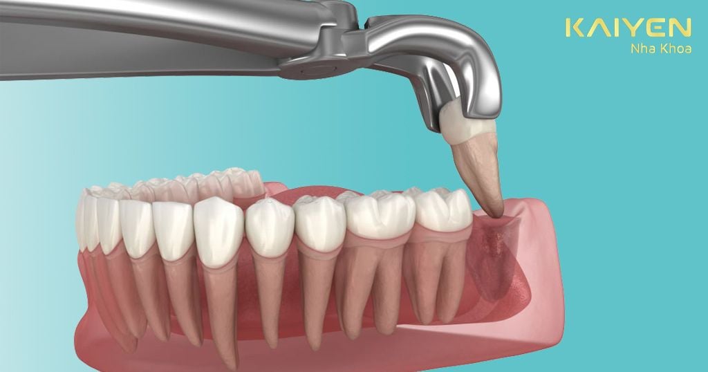 Nhổ răng số 8 diễn ra khá nhanh chóng giúp hạn chế đau nhức