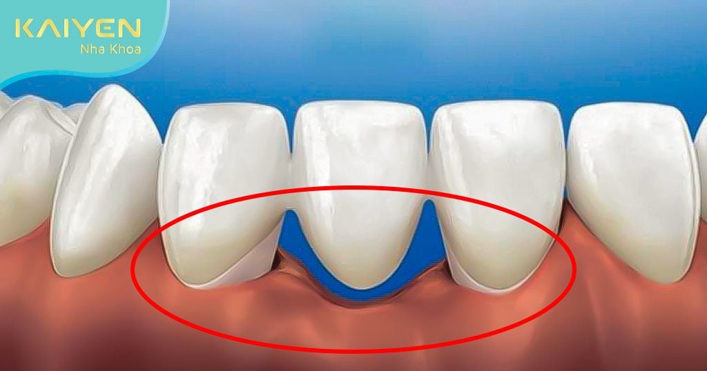Cầu răng sứ có tuổi thọ không cao do tình trạng tiêu xương hàm diễn ra