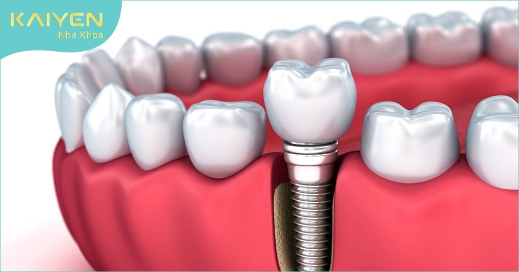 Trồng răng Implant – Giải pháp trồng răng giả tối ưu nhất