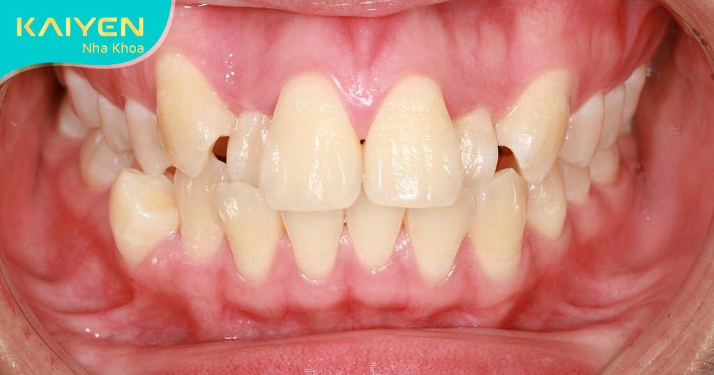 Răng mọc sai khớp cắn gây ra nhiều tổn thương răng miệng