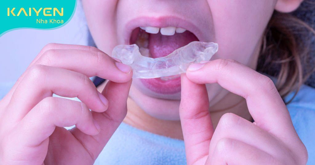 Cần niềng răng cho bé 7 -8 tuổi sớm