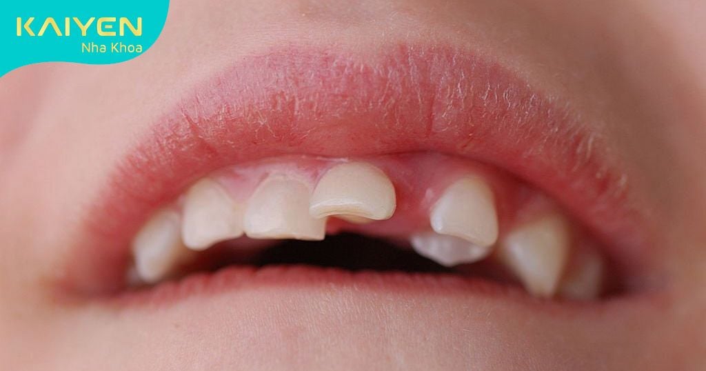 Nên niềng răng cho trẻ khi nào tùy vào tình trạng răng miệng của bé