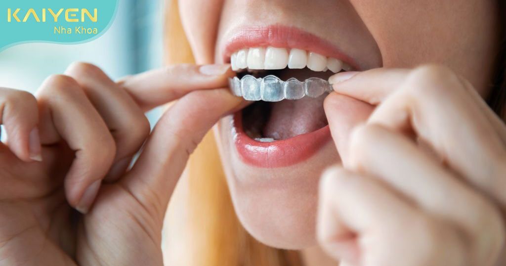 Niềng răng trong suốt invisalign – Phương pháp niềng tối ưu không ảnh hưởng đến phát âm