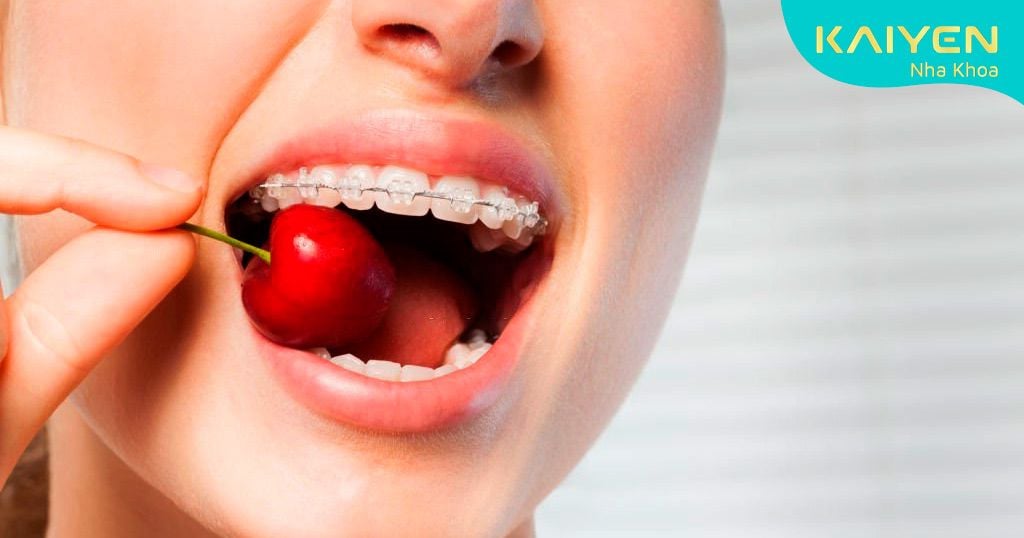 Ăn nhai 1 bên trong quá trình niềng gây hại cho răng