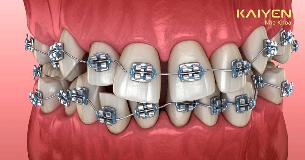Răng khấp khểnh được chỉ định nên niềng răng