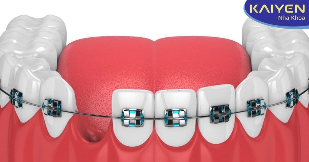 Niềng răng có phải nhổ răng không? Nhổ bao nhiêu răng? Nhổ răng nào?
