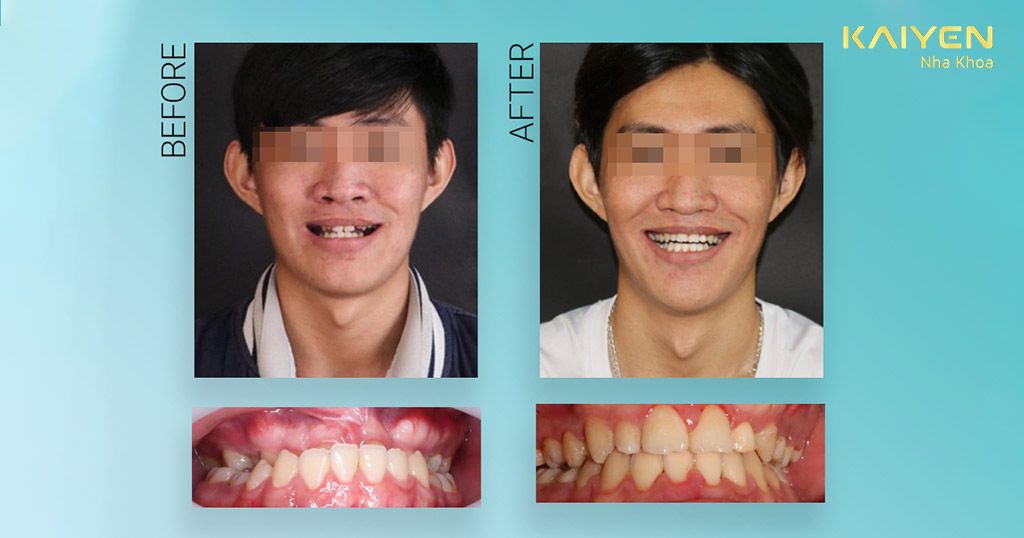 Hình ảnh niềng răng trước và sau của khách hàng KAIYEN