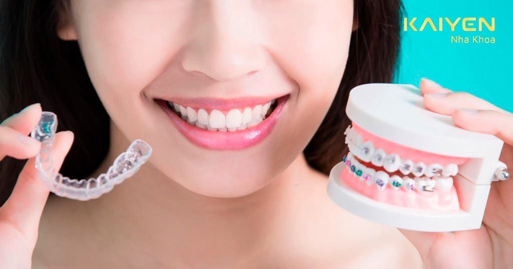 Quá trình niêng răng đẹp như thế nào?