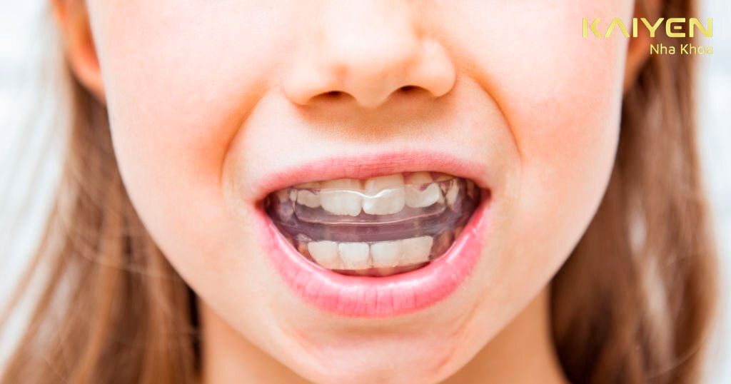 Niềng răng hàm Trainer mang lại hiệu quả tốt nếu được thực hiện bởi các Bác sĩ có tay nghề cao