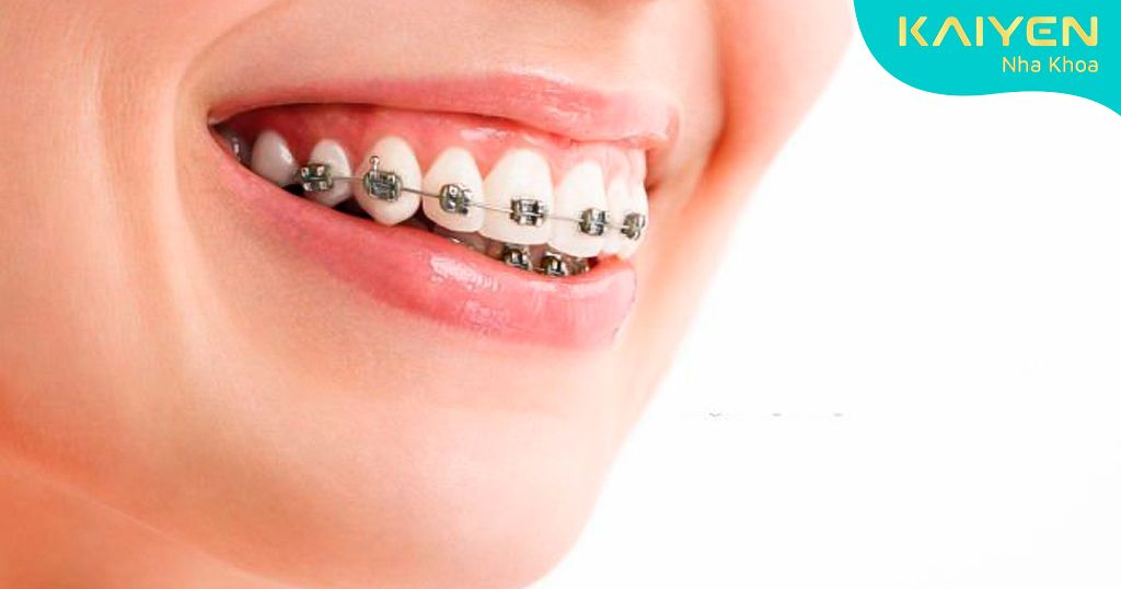 Cười hở lợi là một trong những dấu hiệu niềng răng bị hỏng