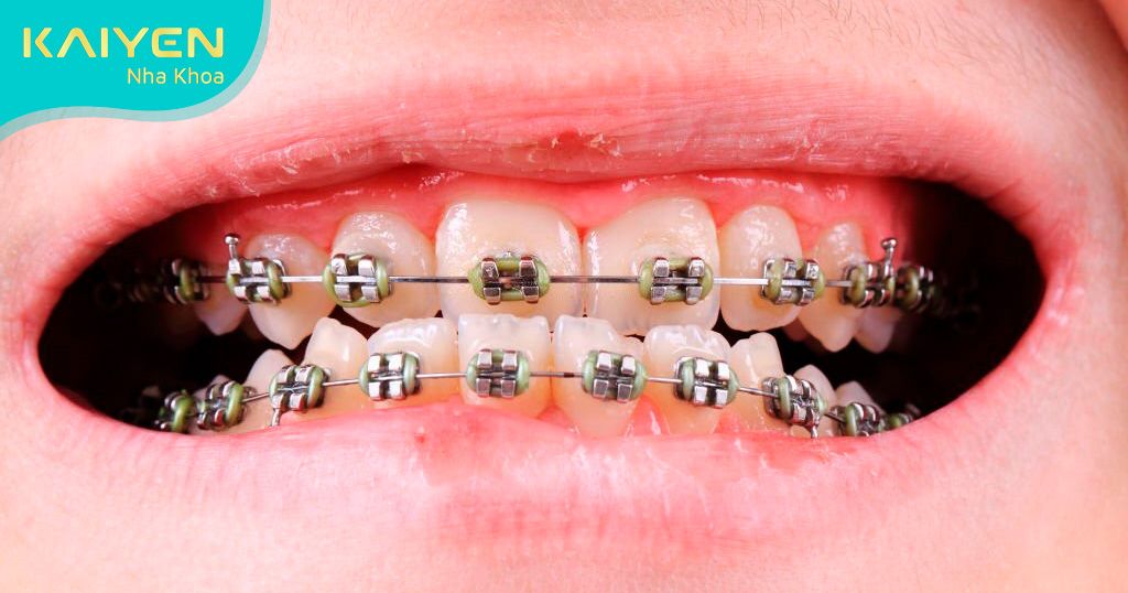 Niềng răng khớp cắn ngược bao lâu có hiệu quả?