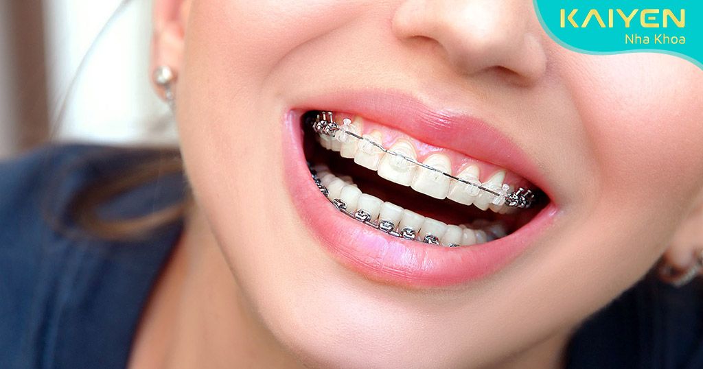 Niềng răng không gây hại cho sức khỏe răng miệng