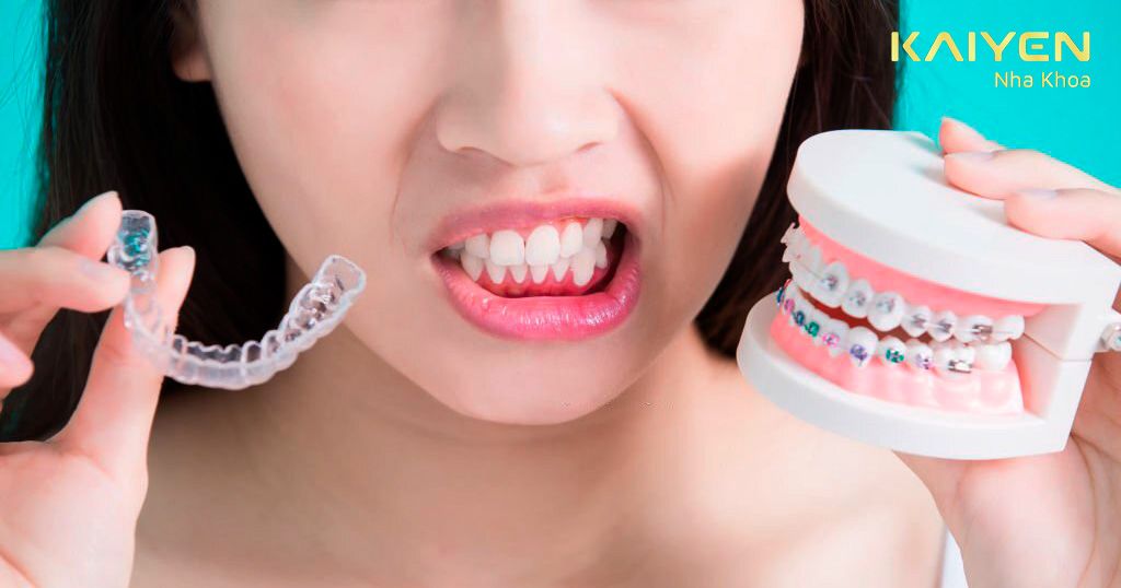 Các phương pháp niềng răng lệch hàm