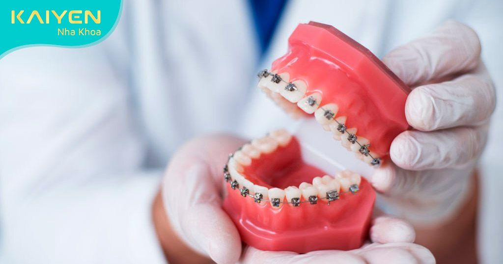 Thời gian niềng răng mắc cài phụ thuộc vào phương pháp điều trị