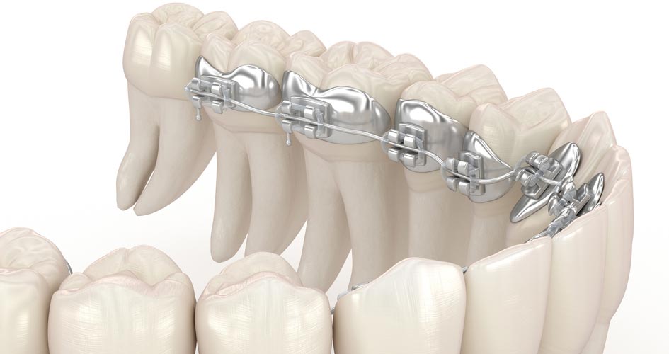 niềng răng mắc cài mặt trong