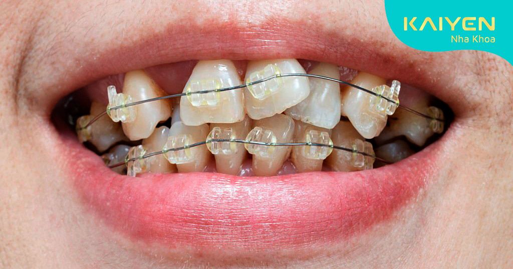 Mức độ lệch lạc của răng ảnh hưởng đến giá niềng mắc cài 3M