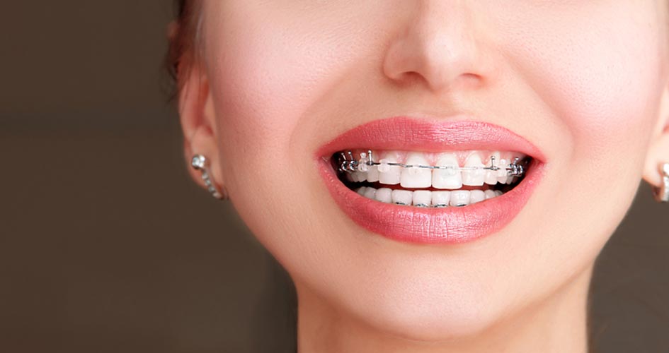 ưu điểm niềng răng kim loại