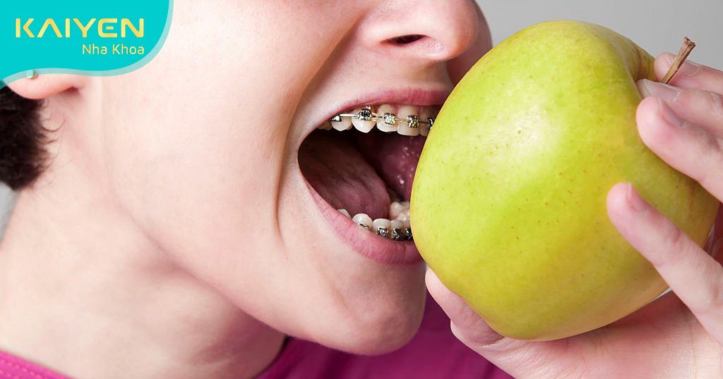 Không nên ăn đồ dai, cứng khi niềng răng