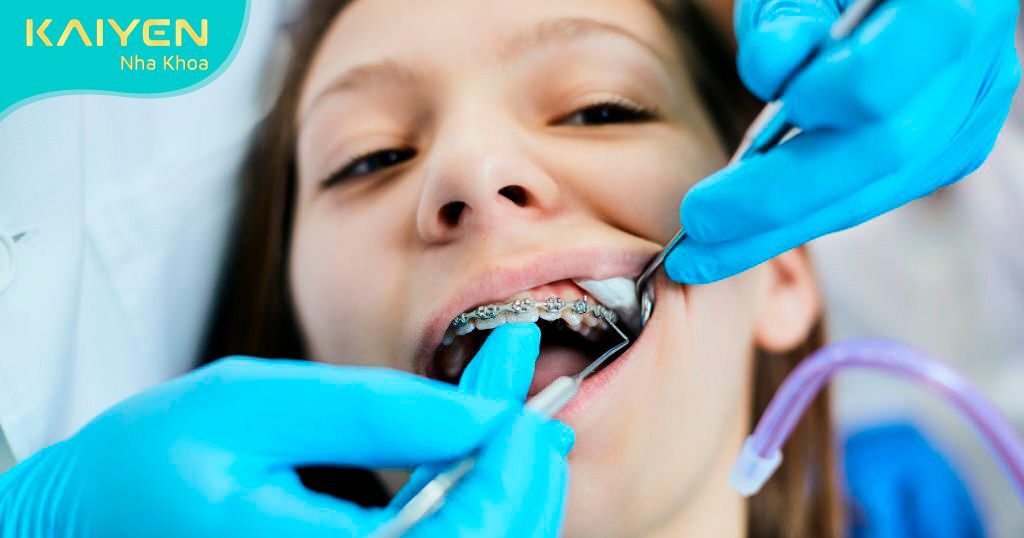 Niềng răng thành công hay không phụ thuộc vào bác sĩ điều trị