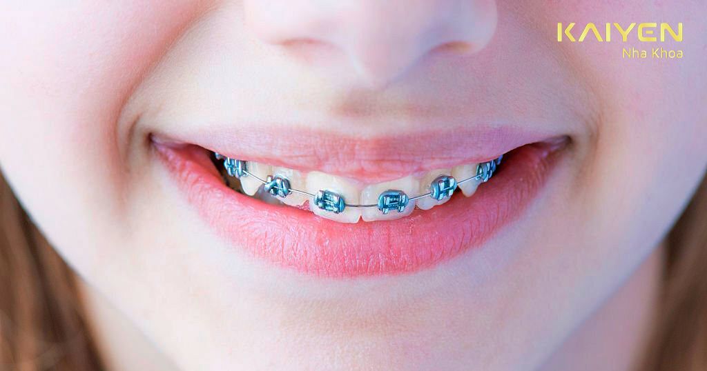 Trẻ từ 12 – 16 tuổi chưa mọc răng khôn
