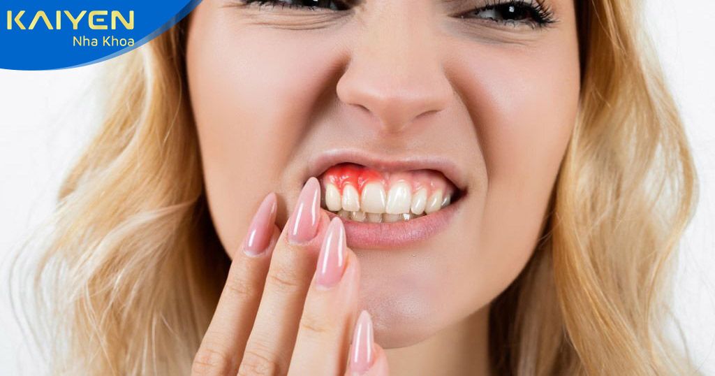 Tự ý chỉnh răng tại nhà gây biến chứng răng miệng