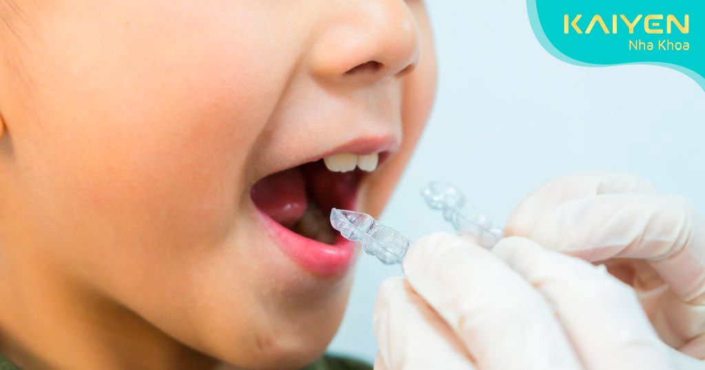 Niềng răng trong suốt ở trẻ em nhanh hơn người lớn