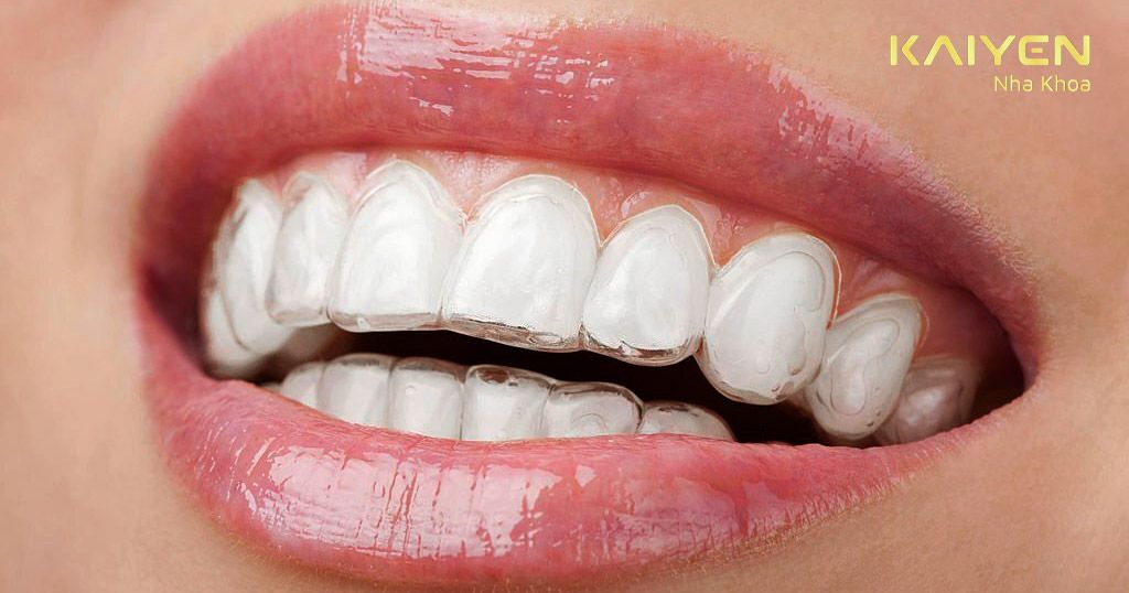 Niềng răng Invisalign sớm giúp mang lại hàm răng trắng sáng