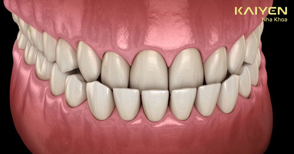 Niềng răng Invisalign cho cả các trường hợp phức tạp