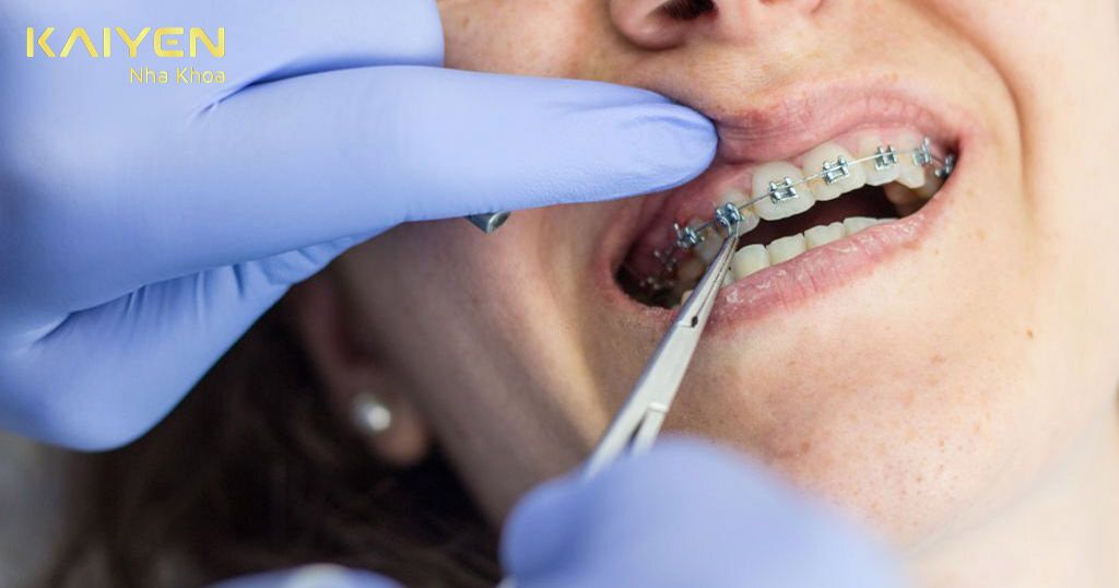 Niềng răng sai kỹ thuật gây hở lợi