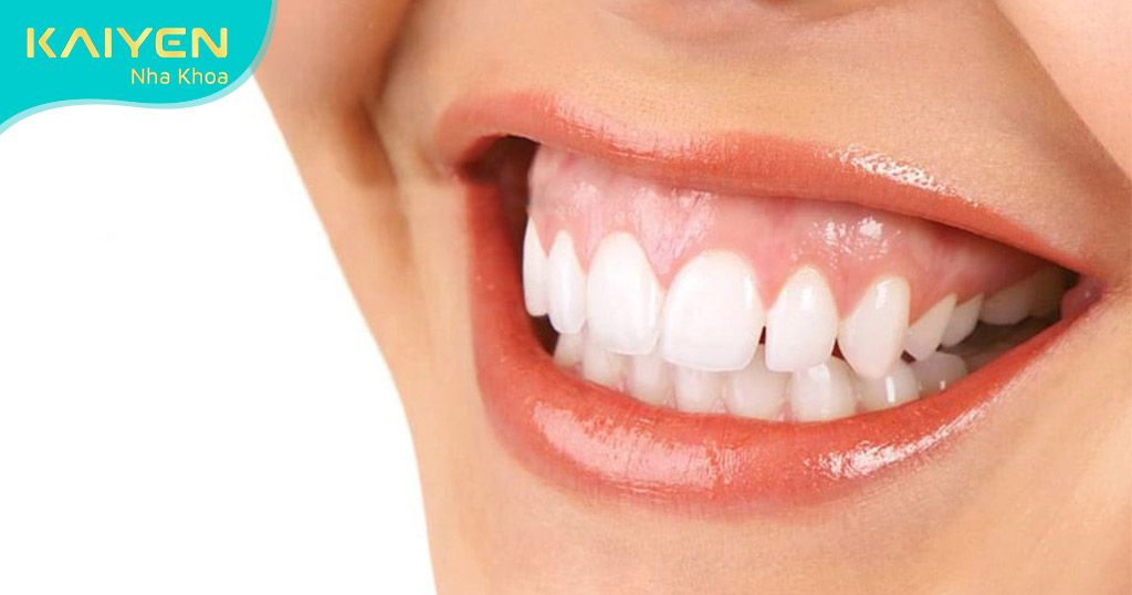 Niềng răng xong bị hở lợi cần khắc phục sớm