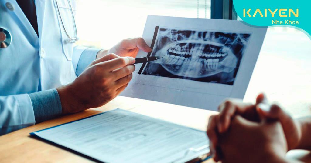 Chụp X-quang để xác định chính xác tình trạng răng