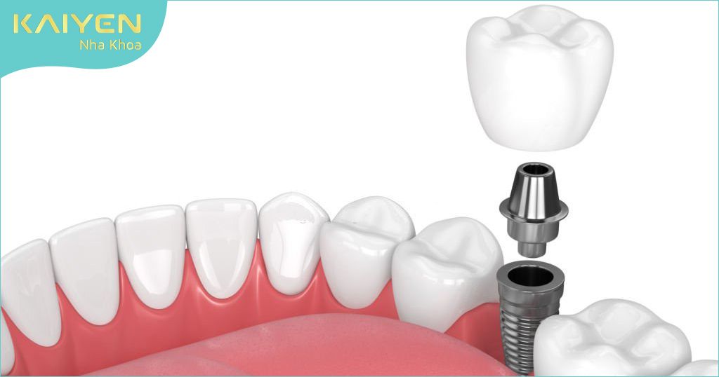 Trồng răng Implant phục hình răng an toàn