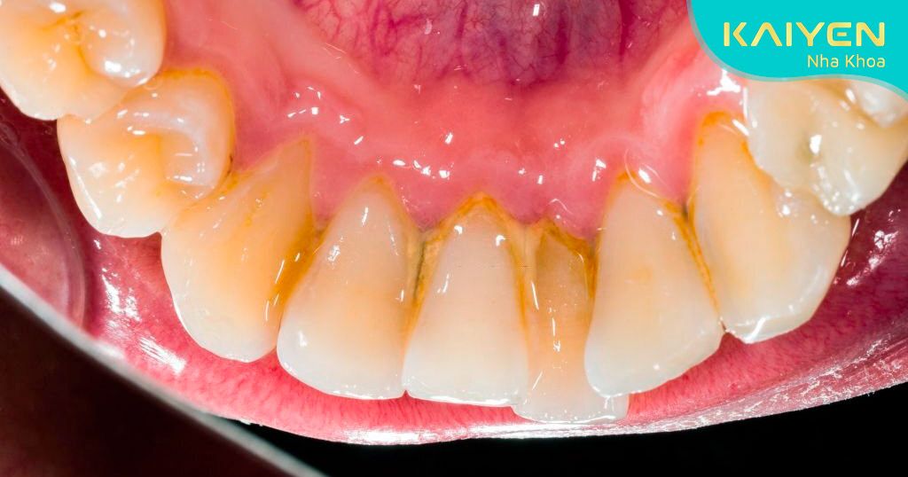 Cao răng Không được vệ sinh gây mất thẩm mỹ và ảnh hưởng đến sức khỏe răng miệng