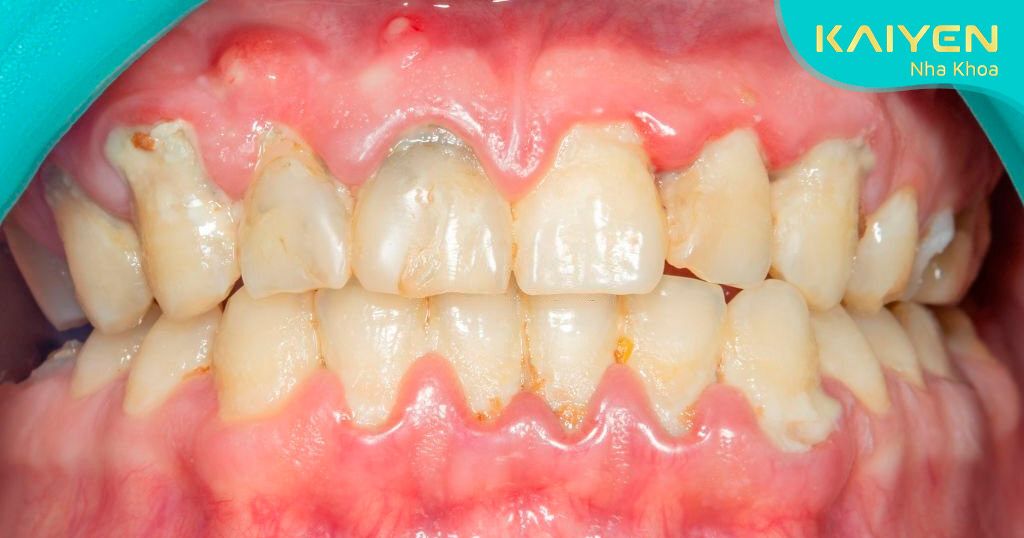 Nên lấy cao răng để cải thiện bệnh lý viêm nướu