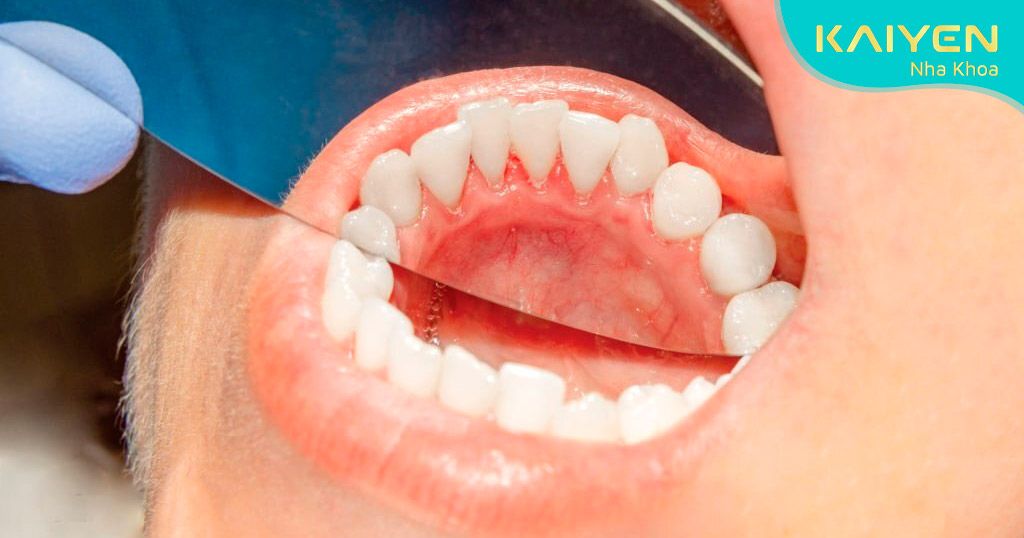 Lấy cao răng định kỳ giúp bảo vệ sức khỏe răng miệng rất hiệu quả