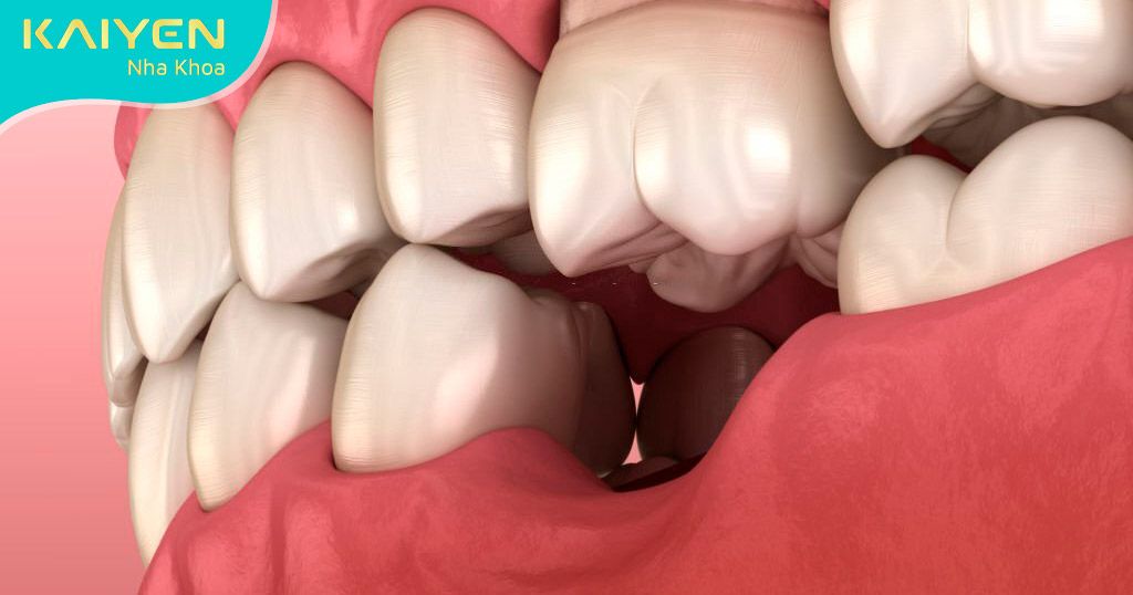 Hậu quả tai hại khi bị mất răng