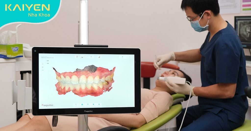 Lấy dấu răng phục hình Implant