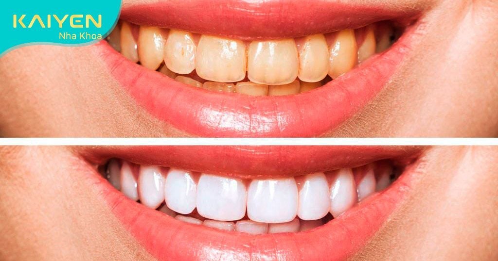Răng bị ố vàng phải làm sao? Cách làm răng hết ố vàng hiệu quả