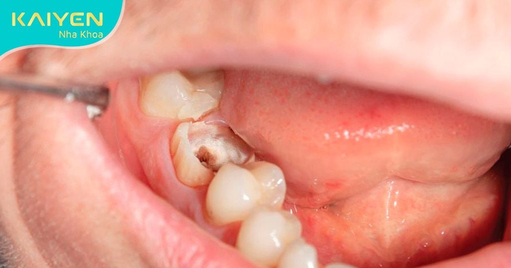 Răng cấm bị lung lay phải làm sao? Nên nhổ hay giữ lại?